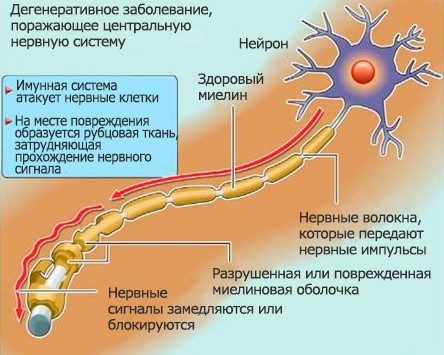 ЛФК при рассеянном склерозе